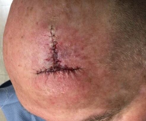 O-T Advancement Flap Before
