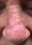 Bi-Rhombic Flap After