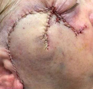 Rotation Flap After