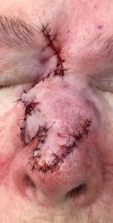 Trilobed Flap Before