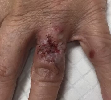 Skin Graft Surgical Repair After