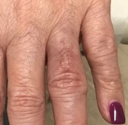 Skin Graft Surgical Repair 2 After