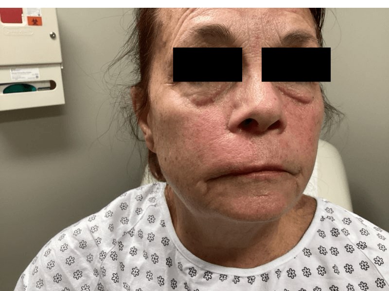 Advancement Flap 5 Month Post Operative View