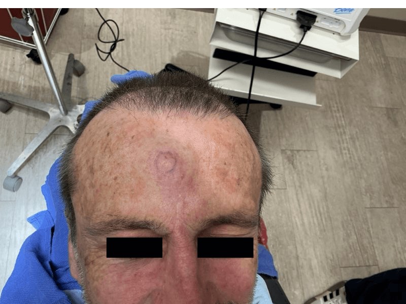 Excision of Malignant Melanoma 11 Months Post Operative View