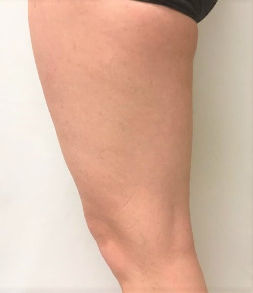 truSculpt iD 2 After