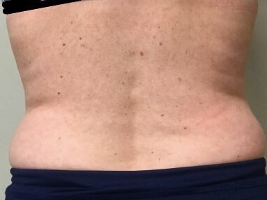 truSculpt iD 3 After