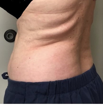 truSculpt iD 3 Before