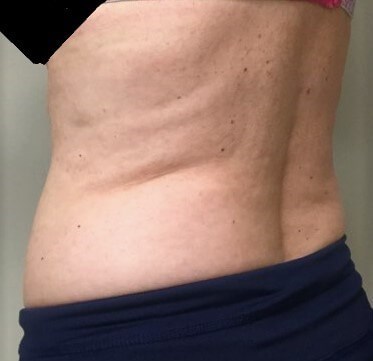 truSculpt iD 3 After