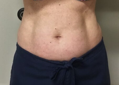 truSculpt iD 3 Before
