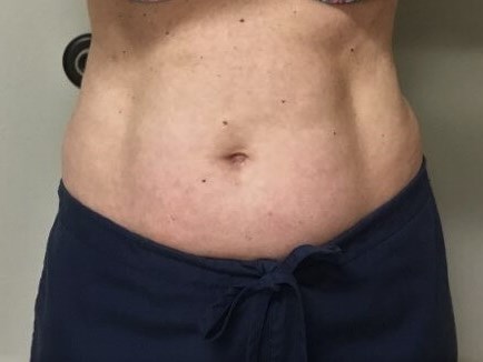 truSculpt iD 3 Before