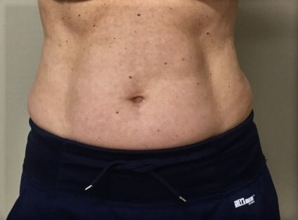truSculpt iD 3 After