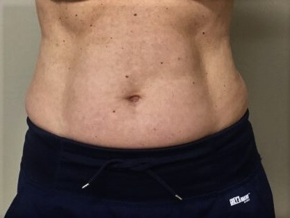 truSculpt iD 3 After
