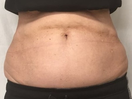 truSculpt iD 4 After