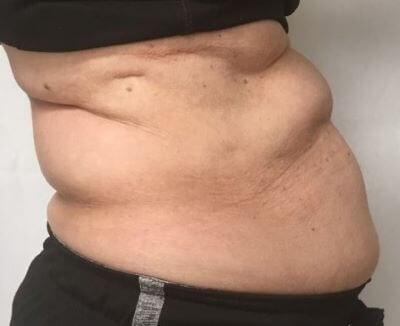 truSculpt iD 4 Before