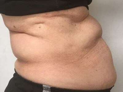 truSculpt iD 4 Before