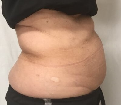 truSculpt iD 4 After