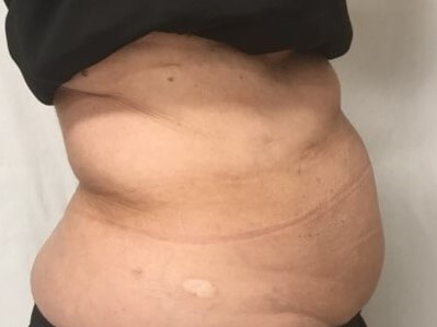 truSculpt iD 4 After