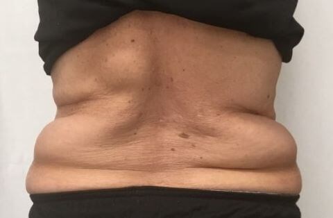 truSculpt iD 4 Before