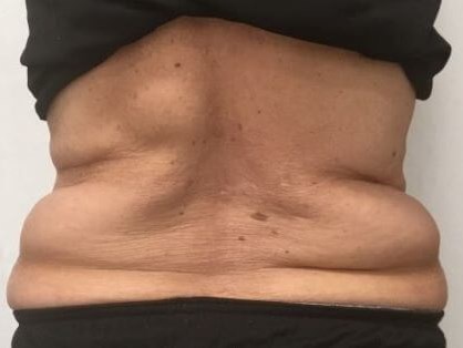 truSculpt iD 4 Before