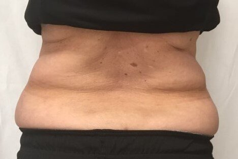 truSculpt iD 4 After