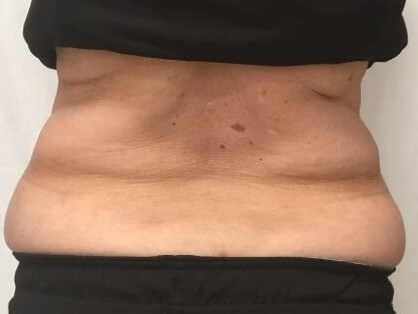 truSculpt iD 4 After