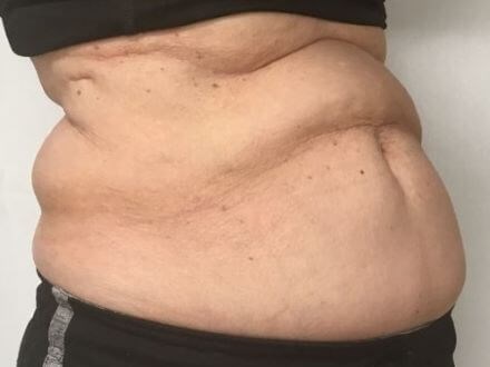 truSculpt iD 4 Before