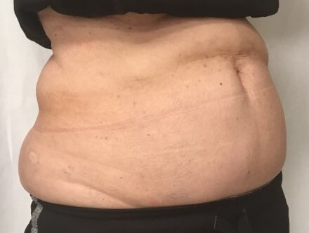 truSculpt iD 4 After