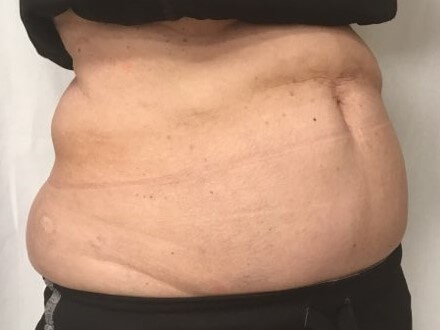 truSculpt iD 4 After