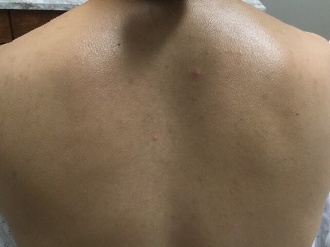 Chemical Peel After