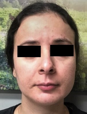 Secret RF with PRP 1 After