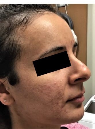 Secret RF with PRP 1 Before