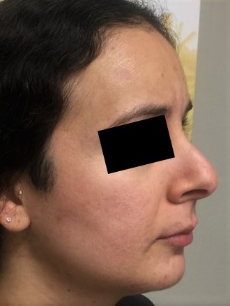 Secret RF with PRP 1 After