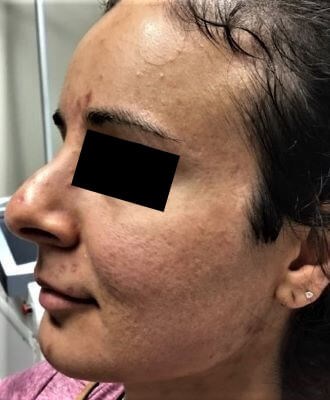 Secret RF with PRP Before
