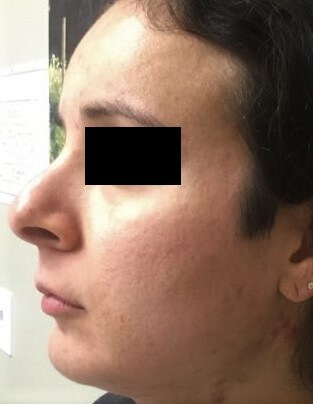 Secret RF with PRP After