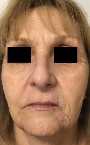 Before and After Nonsurgical Skin Tightening Photos