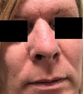 Rotation Flap After