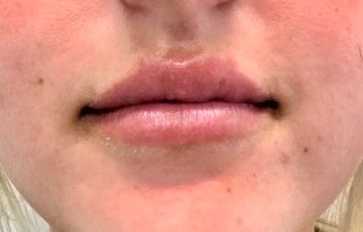 Lip Filler Front View After