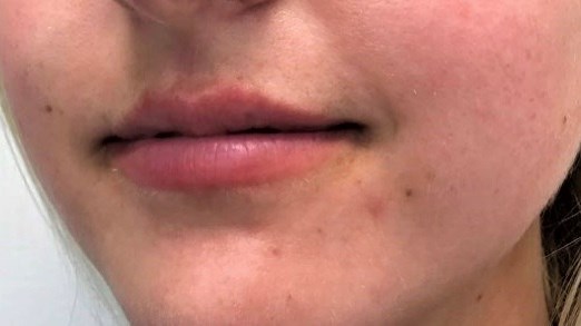 Lip Filler Side View Before