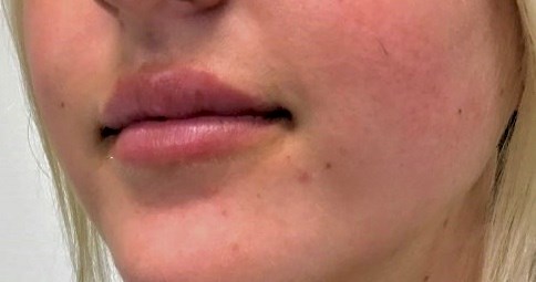 Lip Filler Side View After