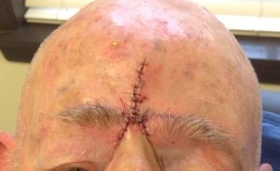 O-T Advancement Flap Before
