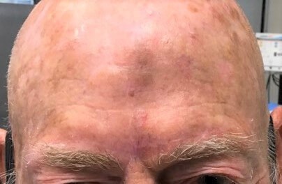 O-T Advancement Flap After