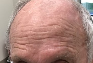O-T Advancement Flap After