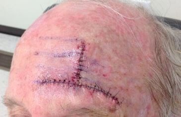 O-T Advancement Flap Before