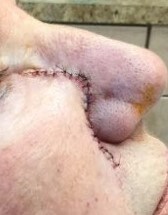 Advancement Flap Before