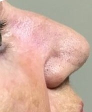 Advancement Flap After