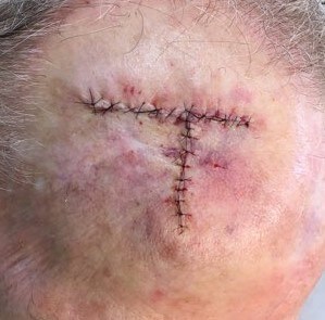 O-T Advancement Flap Before