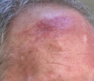O-T Advancement Flap After