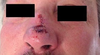 Transposition Flap Before