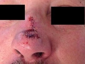 Transposition Flap Before