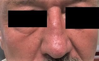 Transposition Flap After